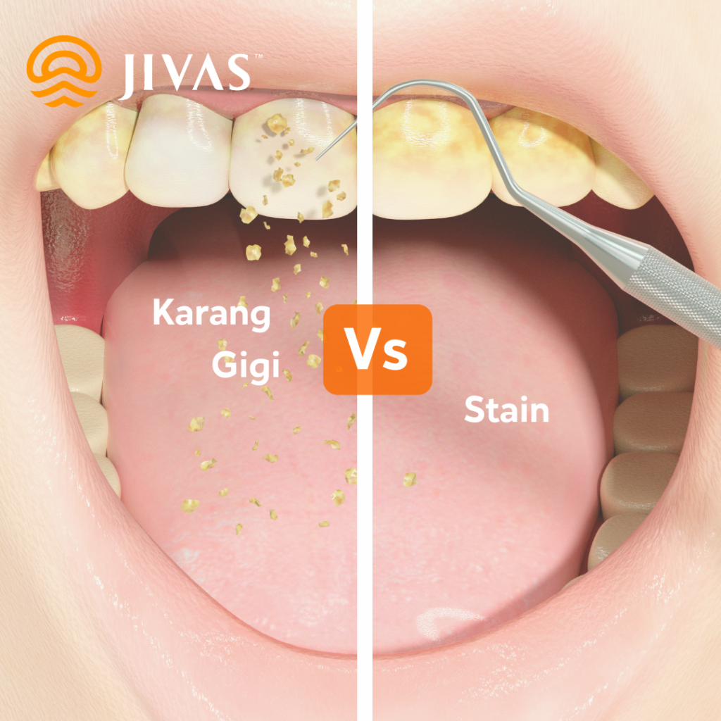 Karang Gigi dan Stain