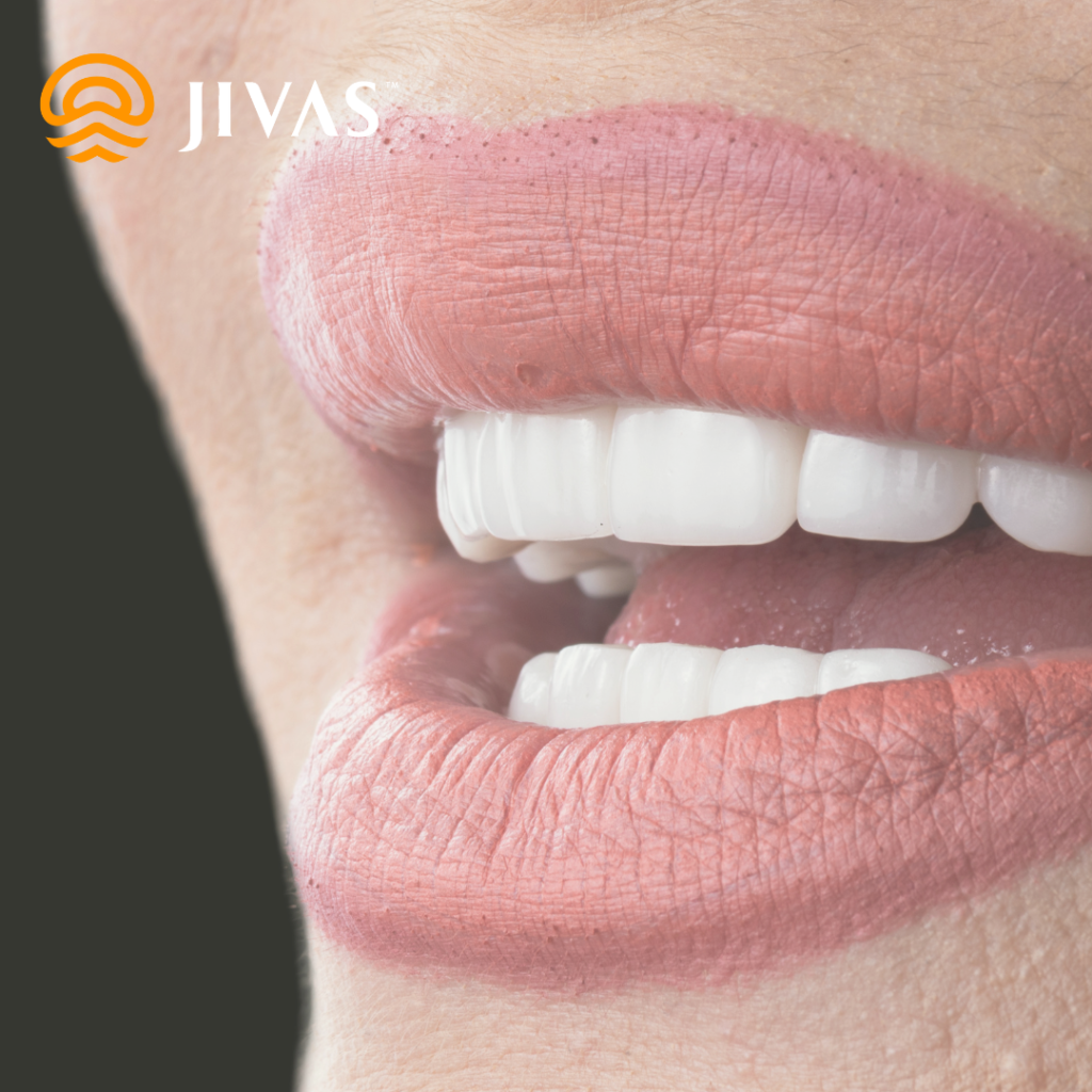 mitos veneer